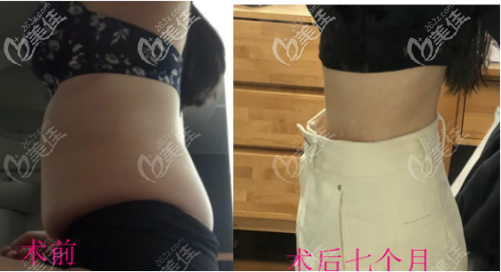 用真實(shí)對(duì)比照回答腰腹環(huán)吸做一次能瘦多少斤？腰圍能掉幾厘米？