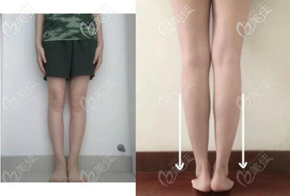 膝蓋內(nèi)側(cè)吸脂前后圖片