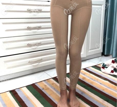 膝蓋內(nèi)側(cè)吸脂+大腿環(huán)吸一個(gè)月恢復(fù)圖片