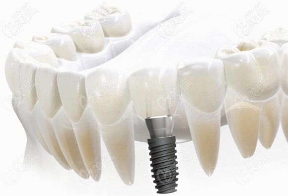 劉天濤醫(yī)生淺談如何判斷種植體的真?zhèn)? alt=