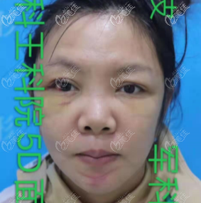 王科醫(yī)生面部小拉皮手術(shù)即刻照片