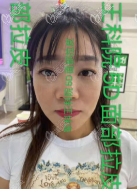重慶王科醫(yī)生面部小拉皮手術(shù)對比照片，花費(fèi)4萬多