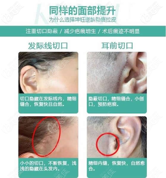 <!--<i data=20240703-sp></i>-->整形小切口手術(shù)切口