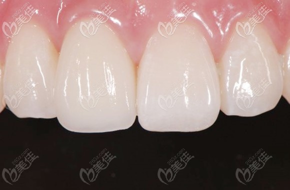 剛在汕頭德瑞口腔種植了一顆前門牙,用的是韓國奧齒泰純鈦材質(zhì)的種植體