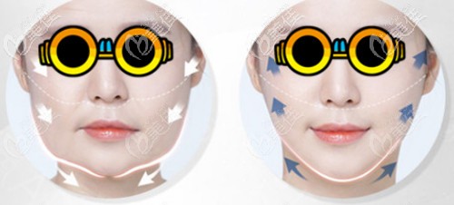 中下面部提升術(shù)包括的部位圖解