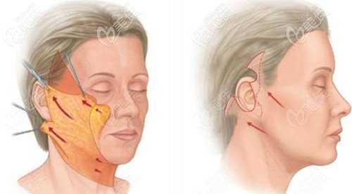 中下面部拉皮手術(shù)過程