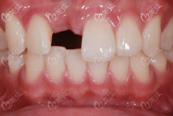 上排右門牙缺失圖 上排右門牙缺失圖