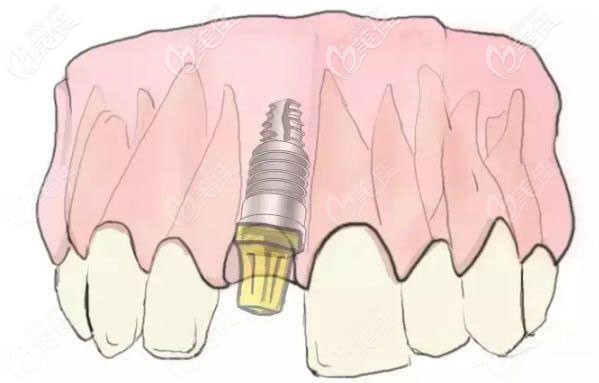 門牙植入種植體和基臺(tái)的效果 門牙植入種植體和基臺(tái)的效果