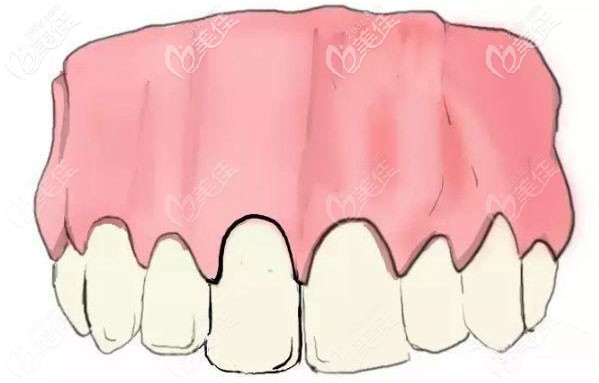 門牙美學(xué)修復(fù)后圖片 門牙美學(xué)修復(fù)后圖片