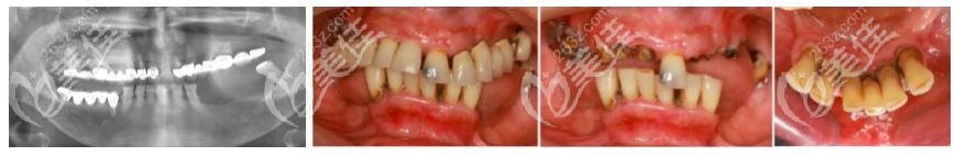 術(shù)前無(wú)牙頜老人口腔情況 術(shù)前無(wú)牙頜老人口腔情況