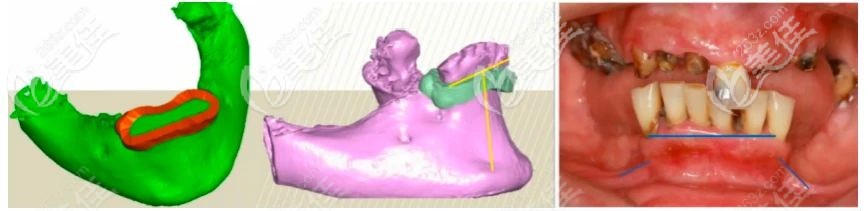老人種植牙方案設(shè)計(jì) 老人種植牙方案設(shè)計(jì)