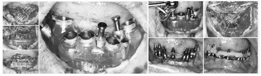 即刻負(fù)重種植牙手術(shù)過(guò)程 即刻負(fù)重種植牙手術(shù)過(guò)程