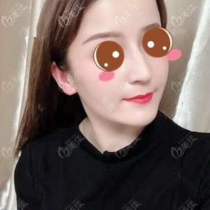 在武漢壹加壹做埋線提升術(shù)后10天