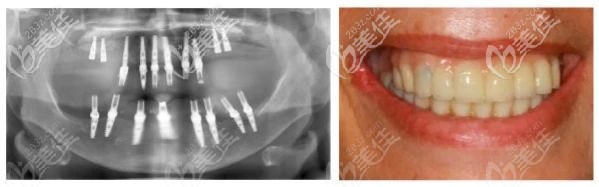老人戴臨時(shí)冠 老人戴臨時(shí)冠