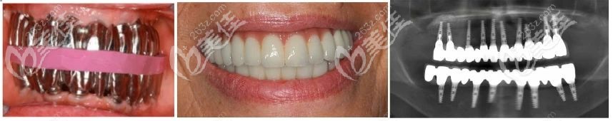 廣州中家醫(yī)口腔的殷龍分享全口無牙頜老人做即刻負(fù)重種植牙案例