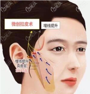 風(fēng)箏小切口拉皮為什么維持時(shí)間更久一些