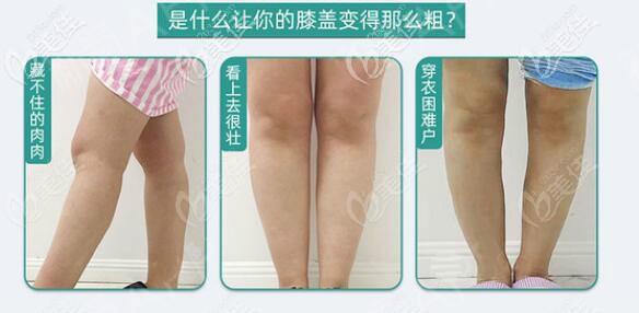 膝蓋抽脂可以單獨做嗎 膝蓋抽脂可以單獨做嗎