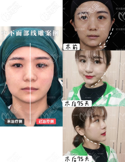 重慶時(shí)光美國(guó)快翎線中下面部 線 雕提升案例 重慶時(shí)光美國(guó)快翎線中下面部 線 雕提升案例