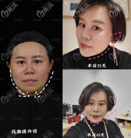 兩個(gè)重慶做的美國快翎線面部線雕案例，效果分別保持了兩年和18個(gè)月