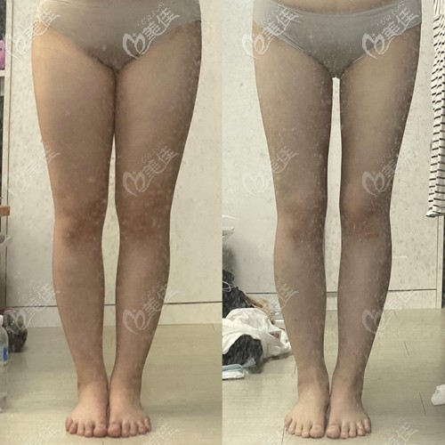 無限蘭斯吸脂瘦大腿前后對比