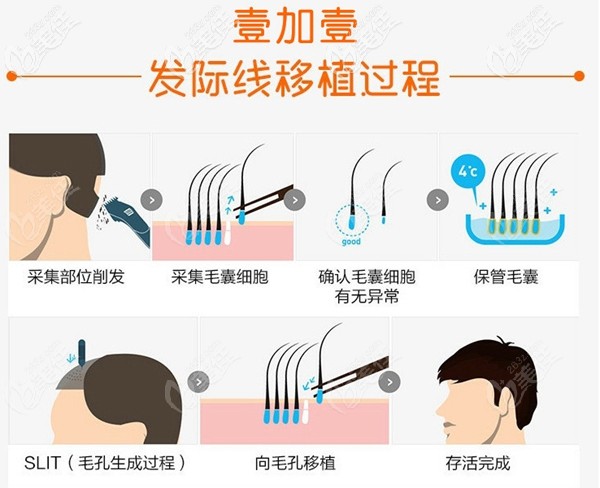 蕪湖壹加壹植發(fā)手術(shù)過程