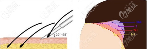 蕪湖壹加壹植發(fā)手術(shù)優(yōu)勢