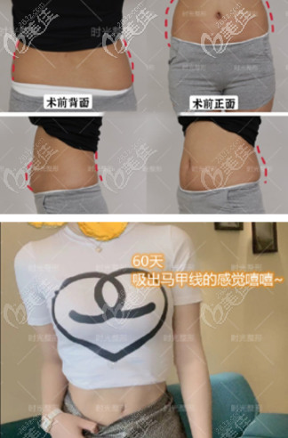 重慶時(shí)光孔令杰醫(yī)生吸脂+5G天使光雕腰腹吸脂60天效果圖