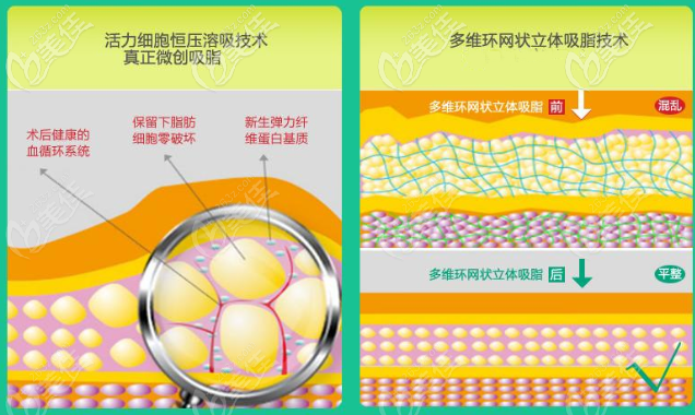 網(wǎng)格化定位吸脂