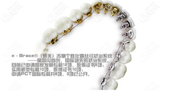 馬瀧齒科的eBrace舌側托槽矯正