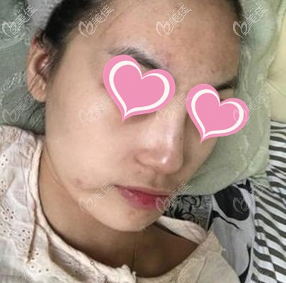 埋線提升手術(shù)前 埋線提升手術(shù)前