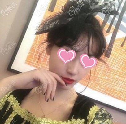 用美國快翎線做的中面部埋線提升蘋果肌復(fù)位2個月了,沒感覺臉寬啊