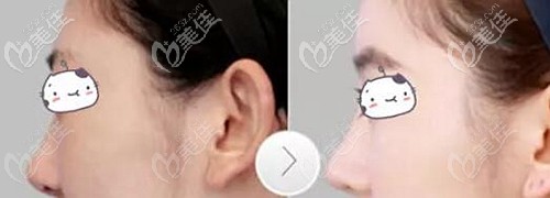 仇侃敏醫(yī)生隆鼻案例 仇侃敏醫(yī)生隆鼻案例