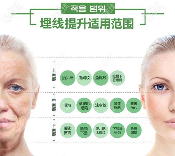 埋線提升使用范圍