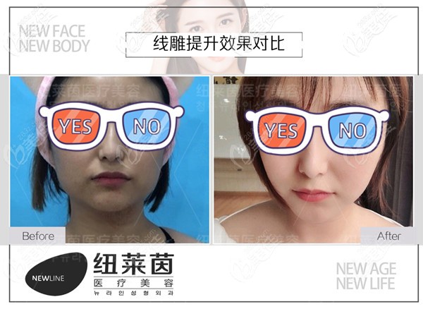 <!--<i data=20240703-sp></i>-->埋線提升案例效果圖