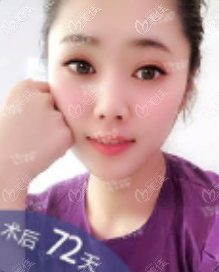 北京雅靚吸脂怎么樣？我做5g天使光雕面部吸脂案例效果參考