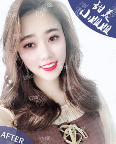 在北京雅靚做5g天使光雕面部吸脂約十天基本消腫,恢復(fù)期不算太久