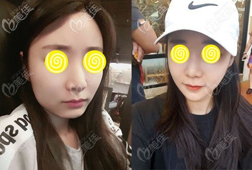 韓國EU外科下頜角磨骨案例