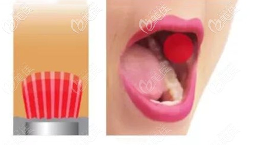 歐洲之星口內技術原理