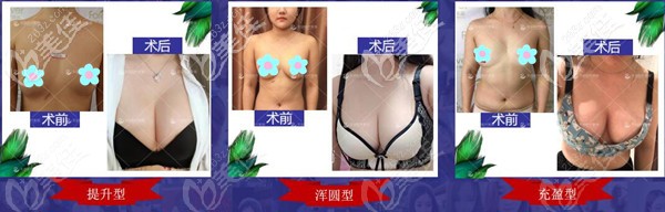 成都恒博天姿李烈院長隆胸案例集合