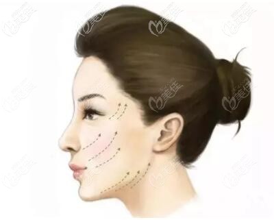 大連達(dá)美元辰醫(yī)療美容做埋線提升效果怎么樣