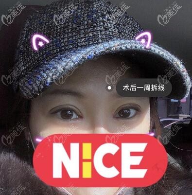 眼綜合修復(fù)術(shù)后一周拆線