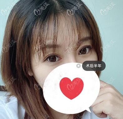 綜合對比大連眼修復(fù)做得好的醫(yī)生后我選擇達美元辰趙鳳霞，給你們看下術(shù)后半年照！