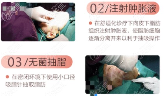 王俊河醫(yī)生做自體脂肪面部填充的技術(shù)優(yōu)勢一 王俊河醫(yī)生做自體脂肪面部填充的技術(shù)優(yōu)勢一