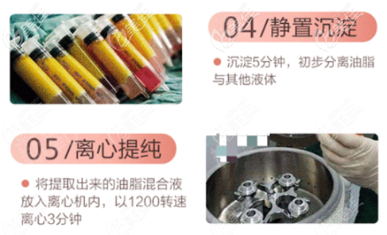 王俊河醫(yī)生面部脂肪填充怎么樣？結(jié)合案例和技術(shù)分析其實(shí)蠻不錯(cuò)的