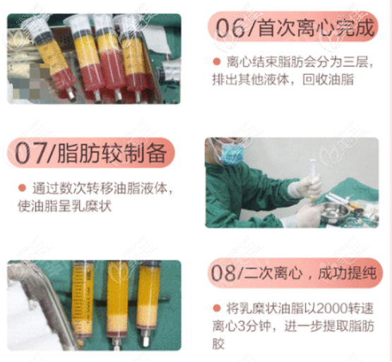 王俊河醫(yī)生做自體脂肪面部填充的技術(shù)優(yōu)勢三 王俊河醫(yī)生做自體脂肪面部填充的技術(shù)優(yōu)勢三