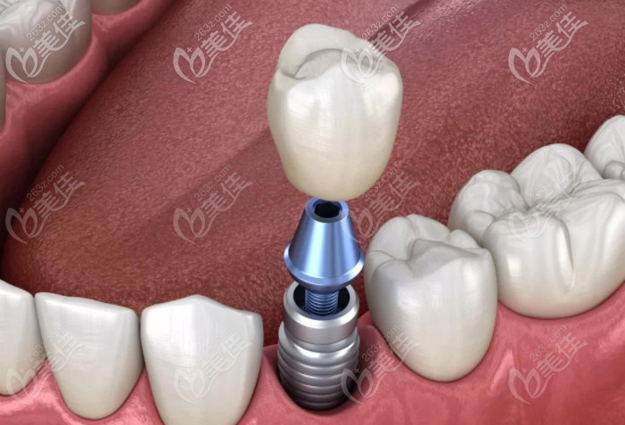 合肥貝杰口腔種植牙多少錢