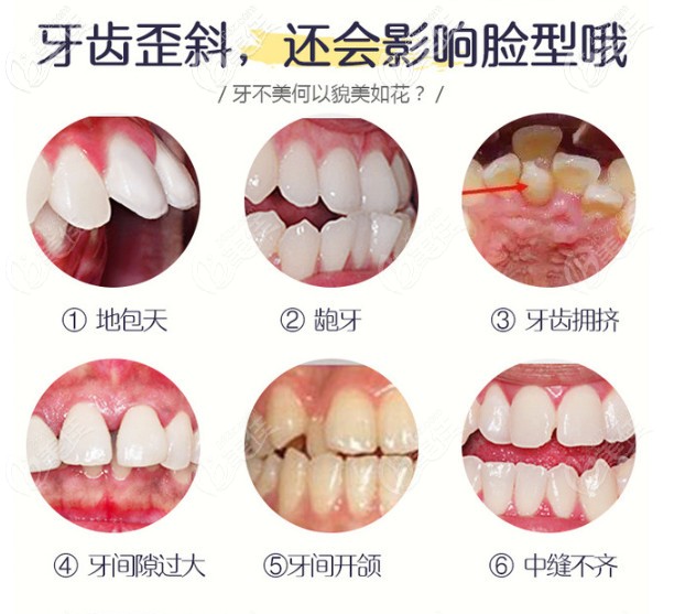 牙齒不齊的類型