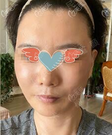 北京柳民熙面部拉皮提升<span style=