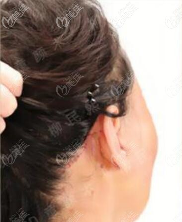 柳民熙院長做的小切口拉皮手術(shù)恢復(fù)三個月疤痕圖片 柳民熙院長做的小切口拉皮手術(shù)恢復(fù)三個月疤痕圖片