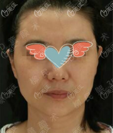 北京柳民熙醫(yī)生小切口拉皮提升<span style=